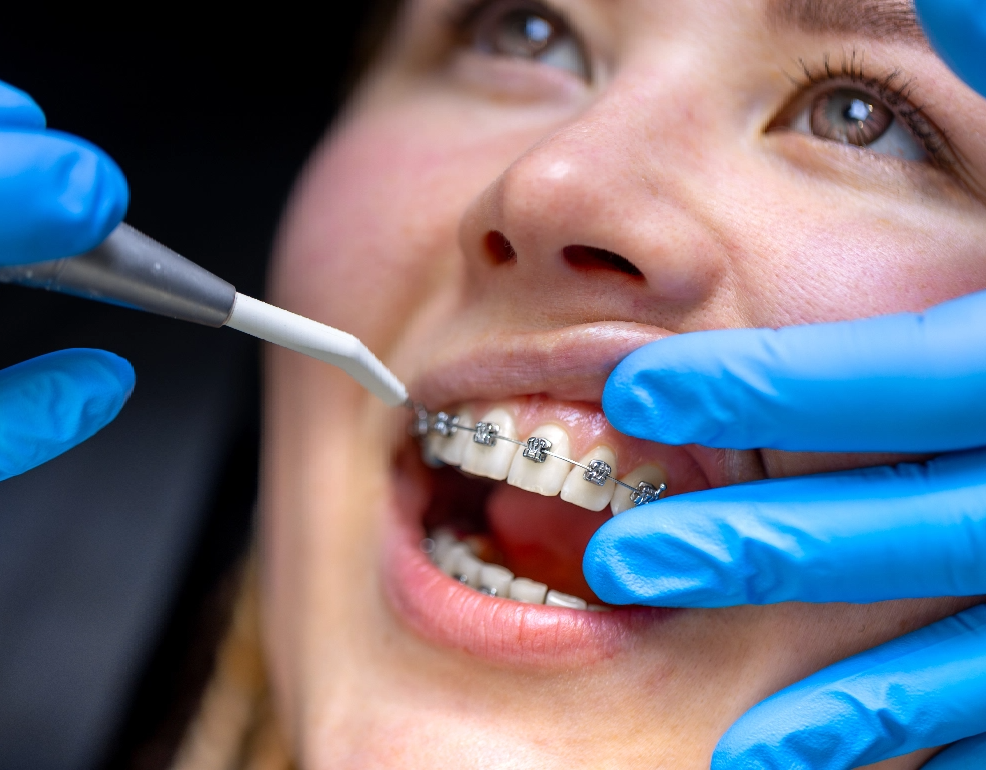 Teen patient with braces at Dr Choonara Orthodontics