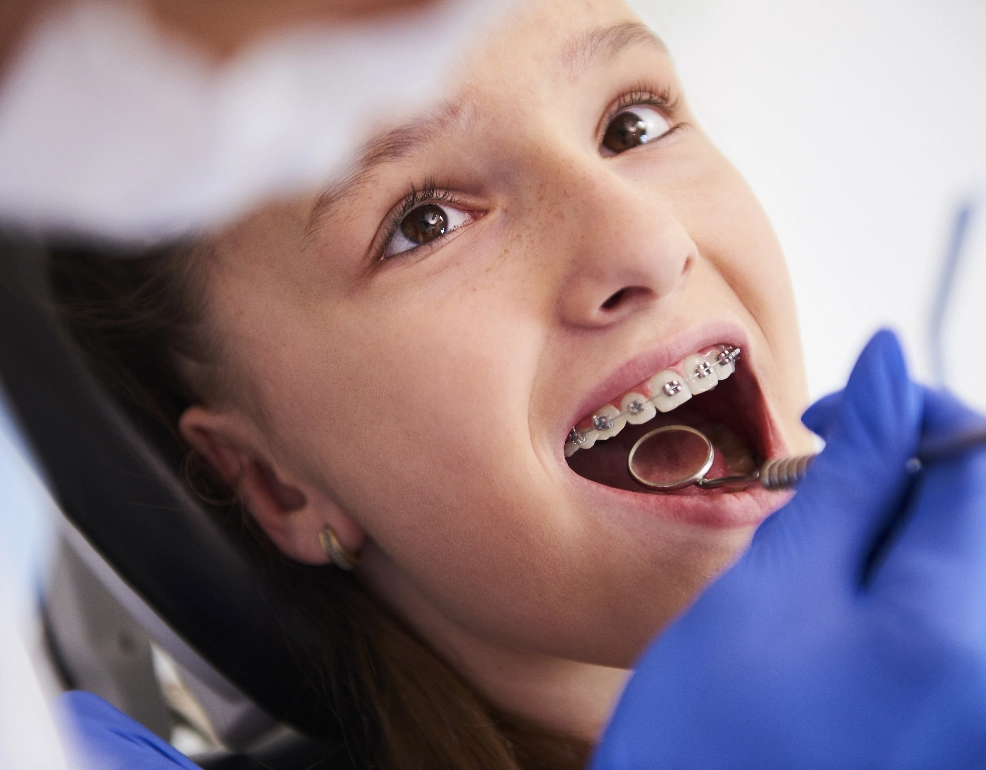 Metal braces fitted by Dr Choonara Orthodontics