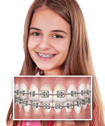 girl-with-metal-braces