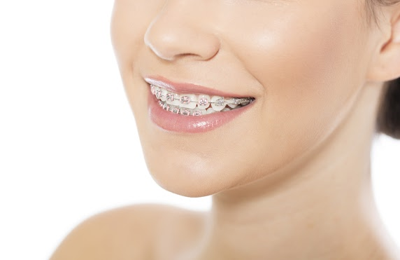 close up of braces